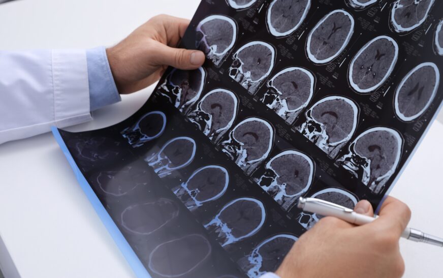 Scleroza multipla: cauze, simptome si tratament recomandat de un neurolog Cluj