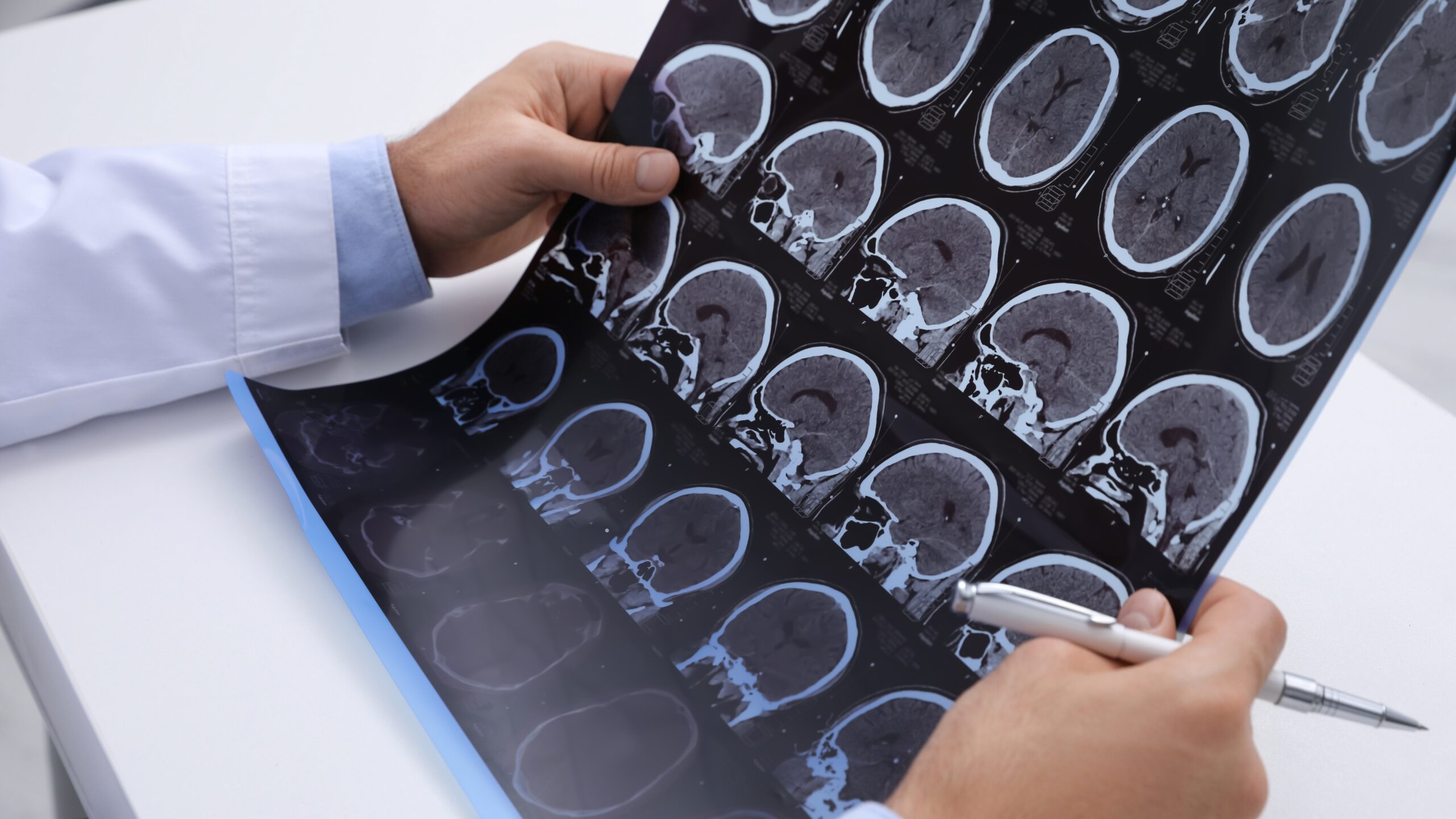 Scleroza multipla: cauze, simptome si tratament recomandat de un neurolog Cluj